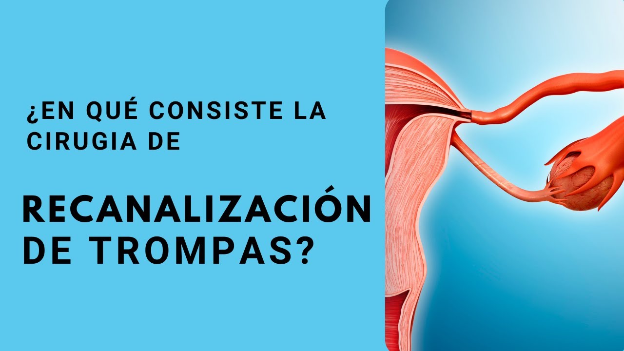 Recanalización de Trompas - Embarazo luego de una ligadura de Trompas