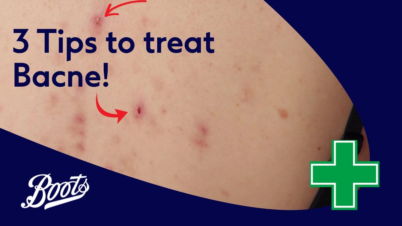 What is bacne? Back acne explained | Meet Our Pharmacy Team | Boots UK