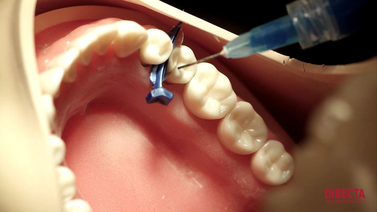 Education Clinical Tips FenderWedge® and Fendermate®