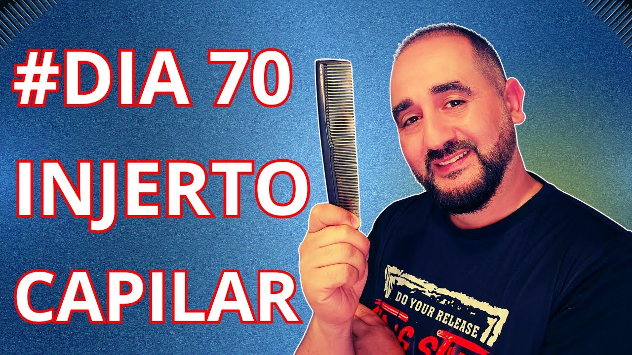 ¿Vale la pena el injerto capilar? Mira mi avance en 70 días