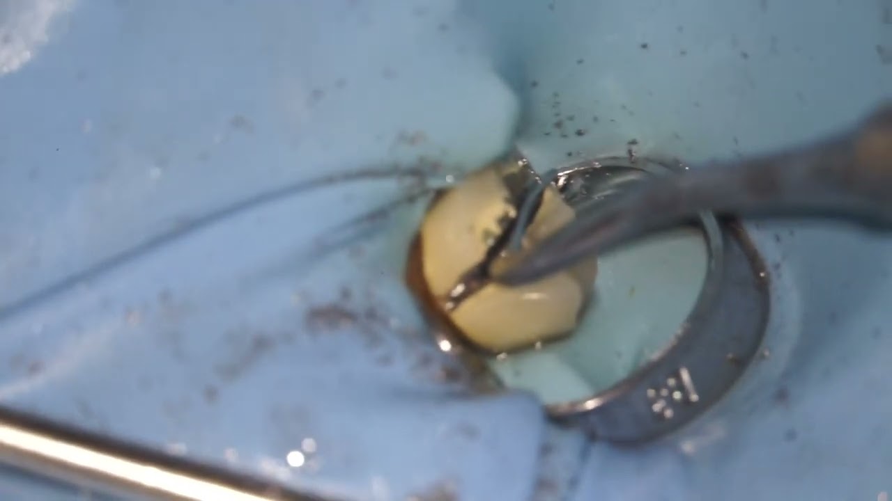 Depose couronne & inlaycore / crown and inlay core removal