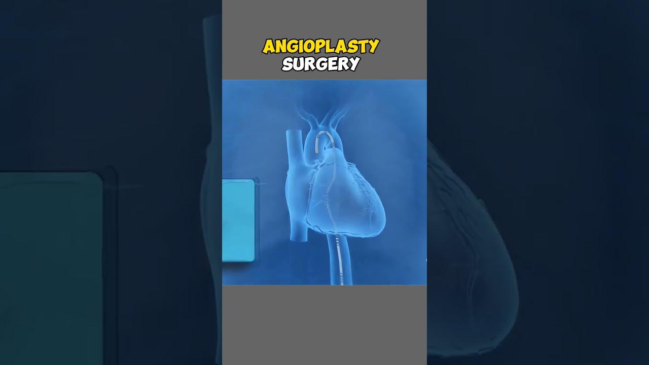 Angioplasty Surgery 3D #shorts