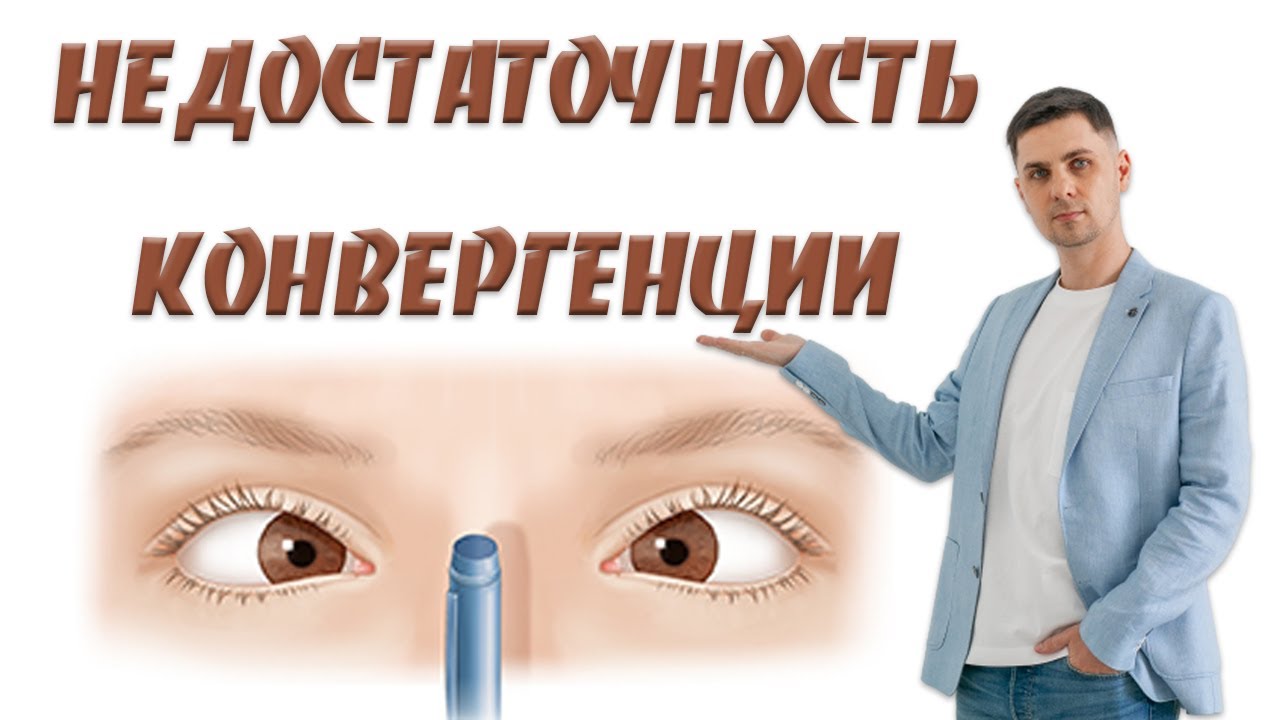 Недостаточность конвергенции причины и лечение