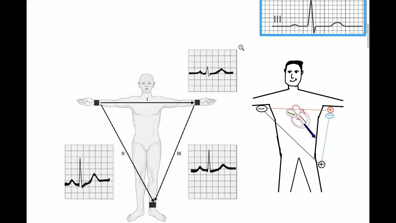 ECG in Bangla: Part 4 (The Augmented Limb Leads)