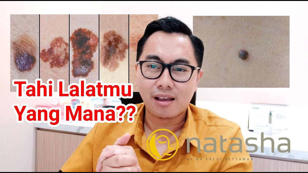 Tahi Lalatmu Ganas? Apa Jinak? Awas Jangan Sembarangan Diambil! | ABCDE kriteria Natasha Sidoarjo