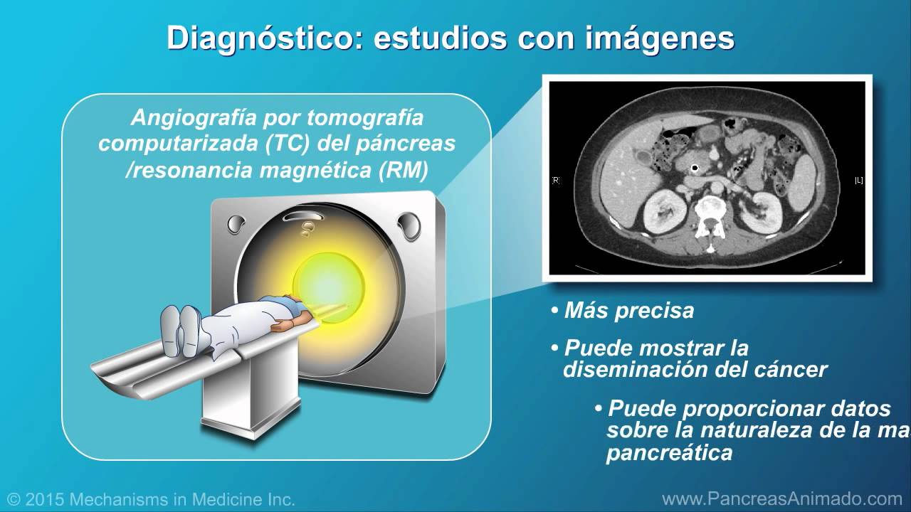 Cáncer de páncreas: fisiopatología, diagnóstico y estadificación