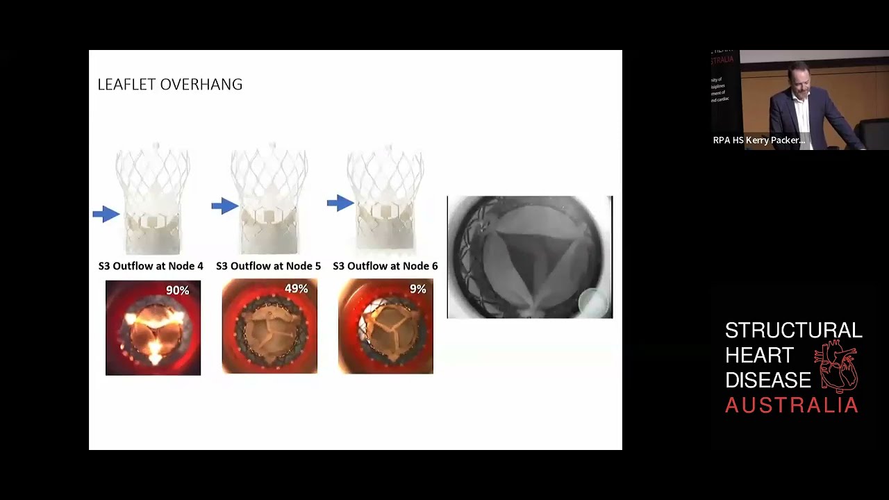 Valve in valve - TAVI and SAVR - A/Prof David Roy