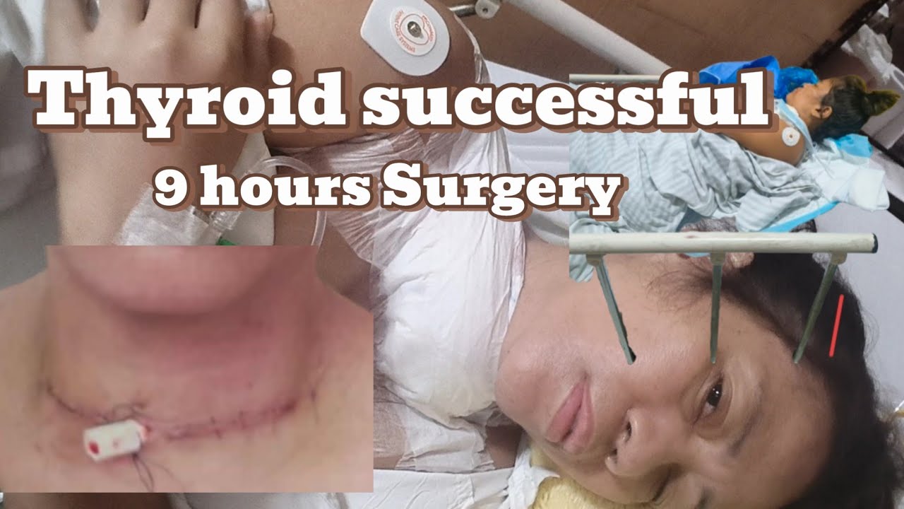 Thyroid successful Surgery Natanggal na Ang Goiter at mga bukol sa Leeg ko