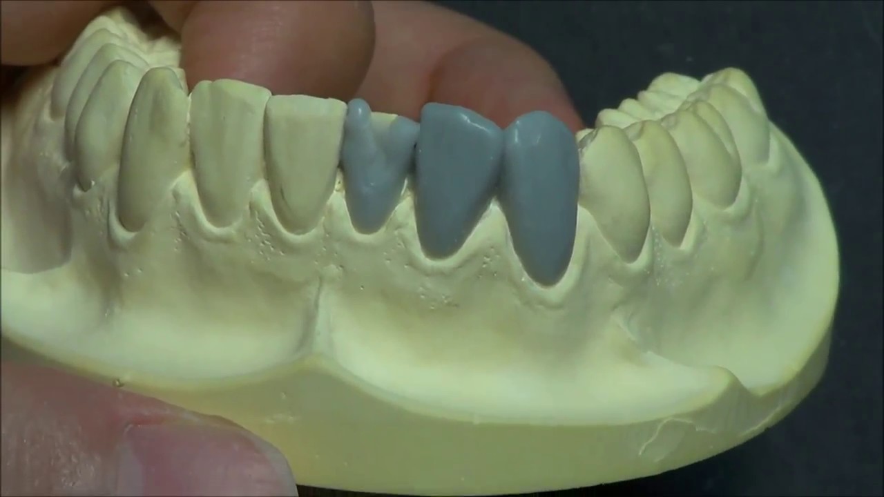 Live wax up - Lower central incisor