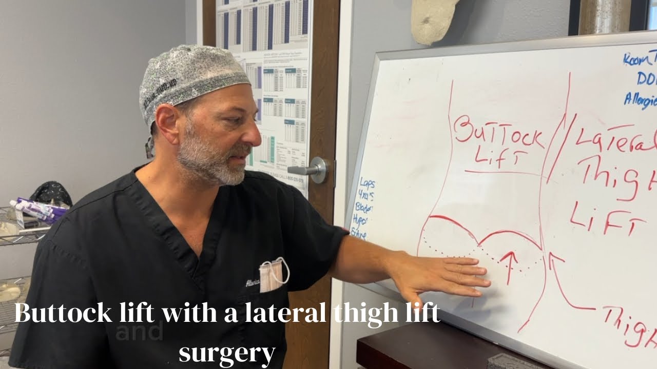 Buttock lift with a lateral thigh lift surgery