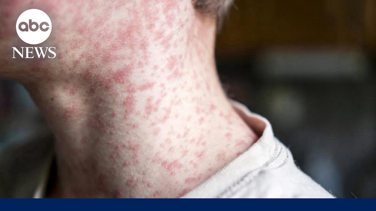 What to know about the measles outbreak in South Carolina