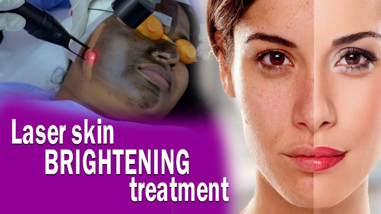 Hollywood Peel  - ලේසර් මගින් සම පැහැපත් කිරීමේ ප්‍රතිකාරය by Consultant Dr Nayani Madarasinghe