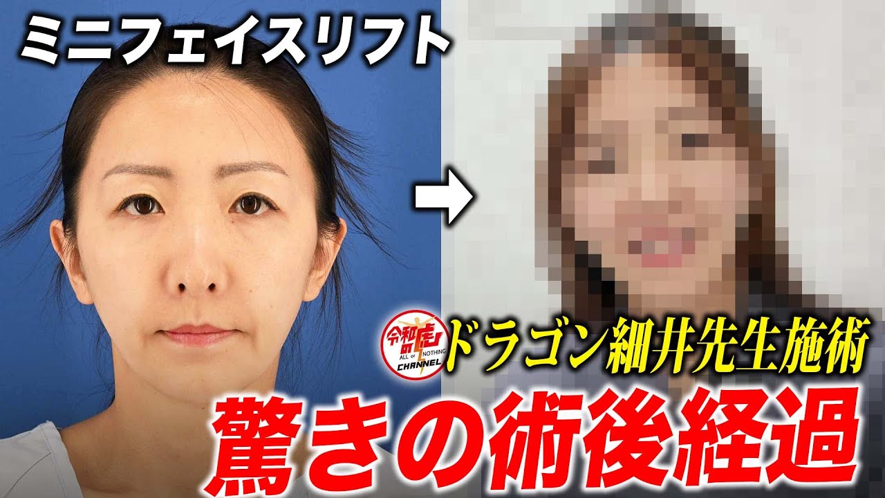 【整形】ドラゴン細井先生によるミニフェイスリフトの結果は？大満足の術後の経過をお話しします。