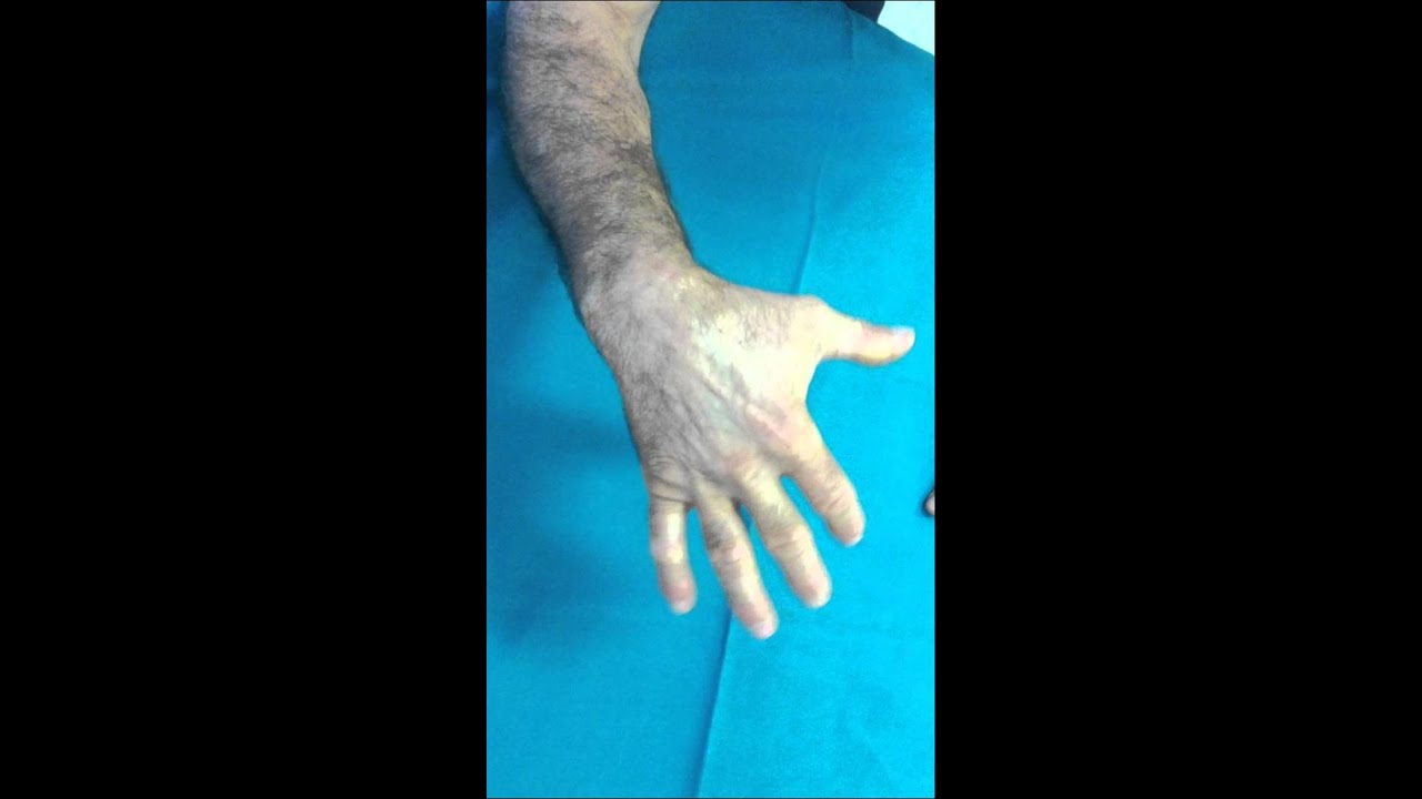 frattura polso controllo ambulatoriale