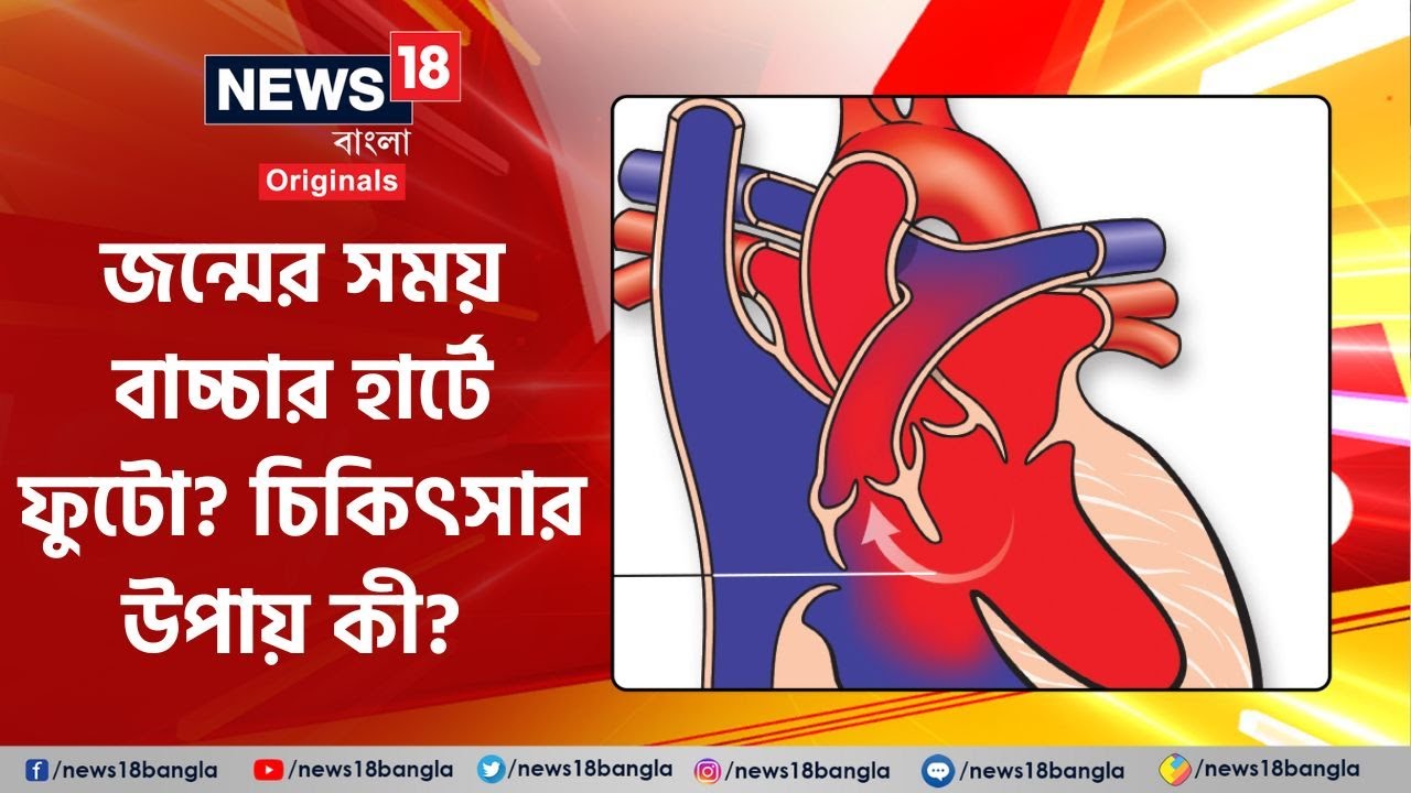 Ventricular Septal Defect:জন্মের সময় বাচ্চার হার্টে ফুটো? চিকিৎসার উপায় কী? #news18banglaoriginals
