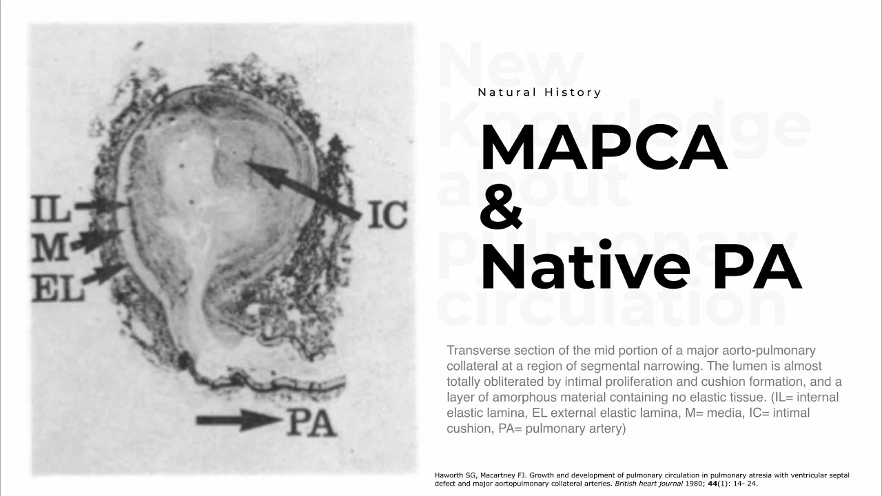 Tetralogy of Fallot, Pulmonary atresia with MAPCA in current practice