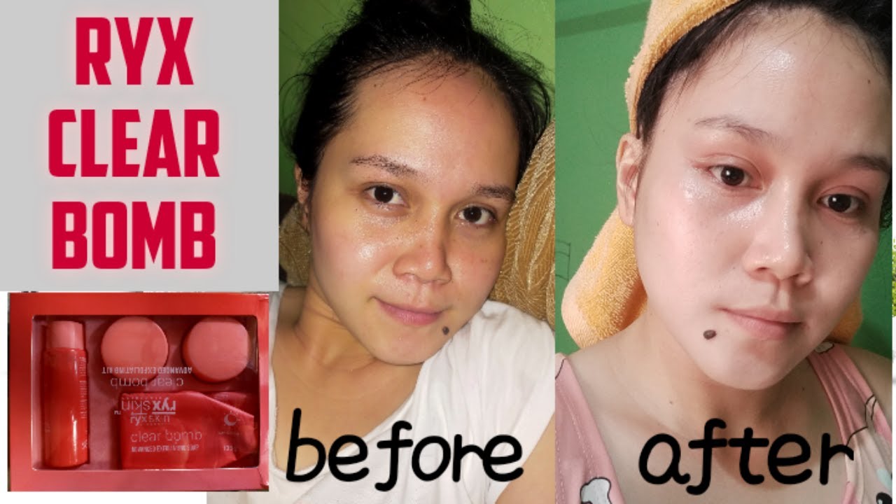 RYX SKIN CLEAR BOMB + Review + Tips / 1 Month Experience | Philippines