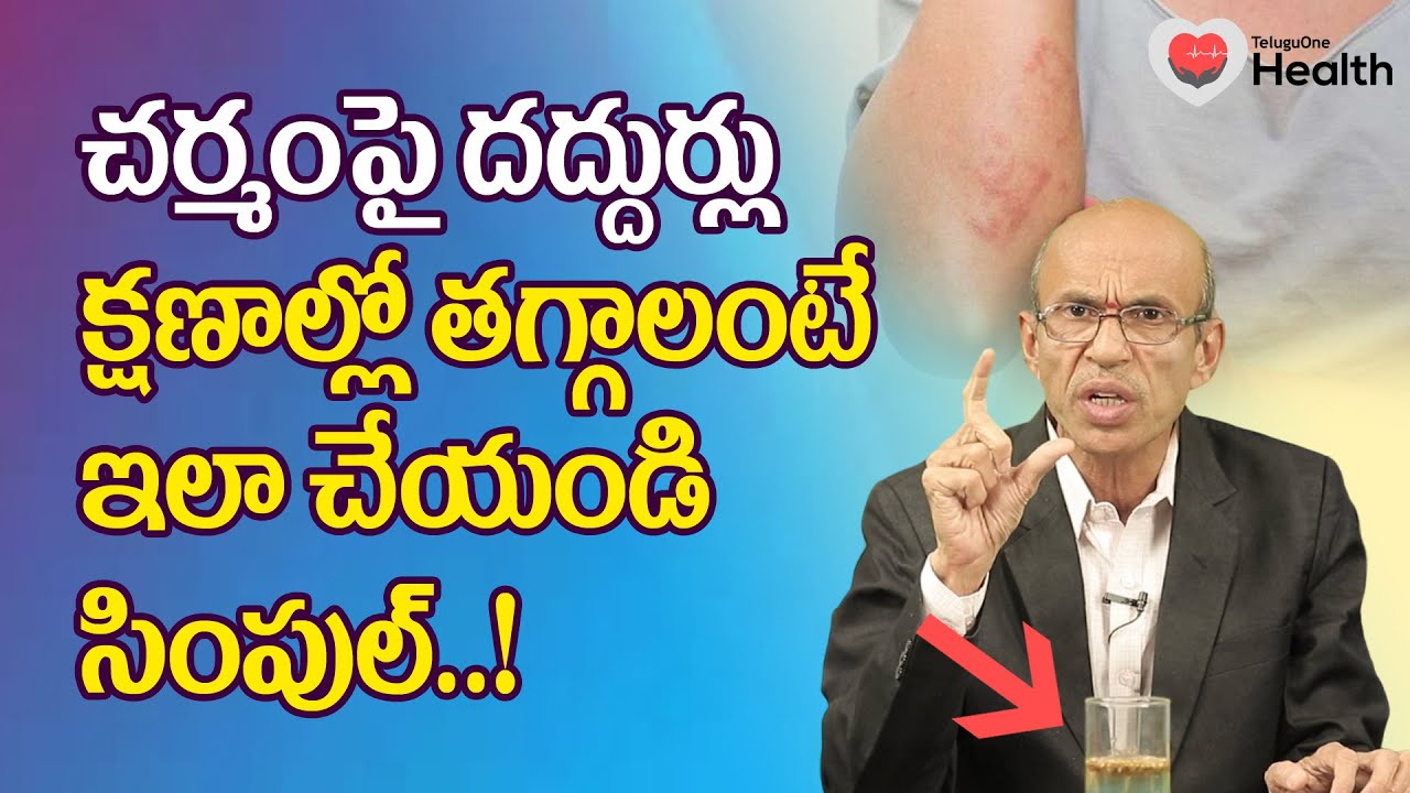 Daddurlu | చర్మం పై దద్దుర్లు క్షణాల్లో తగ్గలంటే.. Dr. Ch Madhusudana Sarma | TeluguOne Health