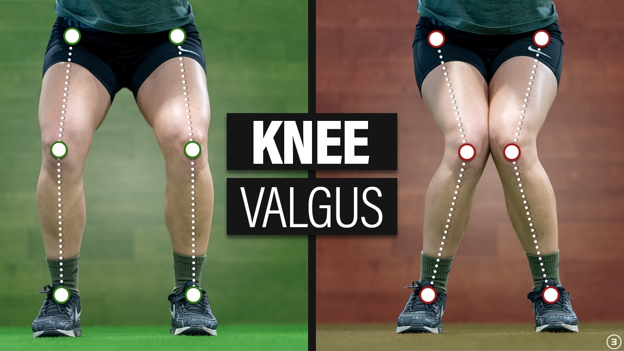The Truth About Knee Valgus