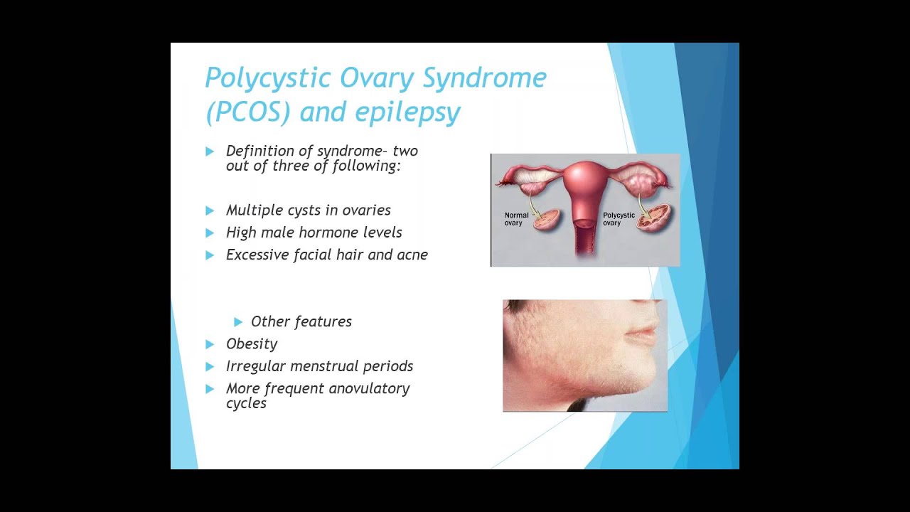 Epilepsy Webinar - Women’s issues