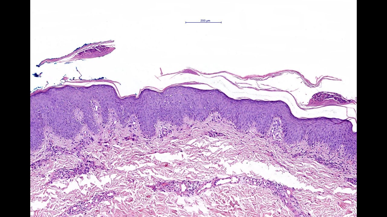 Guttate psoriasis Phillip McKee, Antonina Kalmykova & CSD Health Care