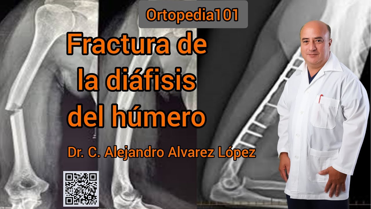 Fractura de la diáfisis del húmero