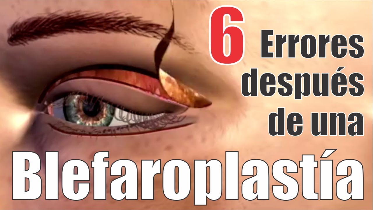 6 ERRORES comunes de PACIENTES luego de su BLEFAROPLASTÍA 👁️ Cirugía de PÁRPADOS❤️ Dr ALBERTO CALVO