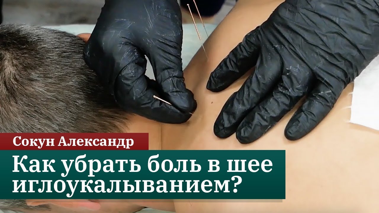 Как убрать боль в шее методом сухой иглы? Сокун Александр