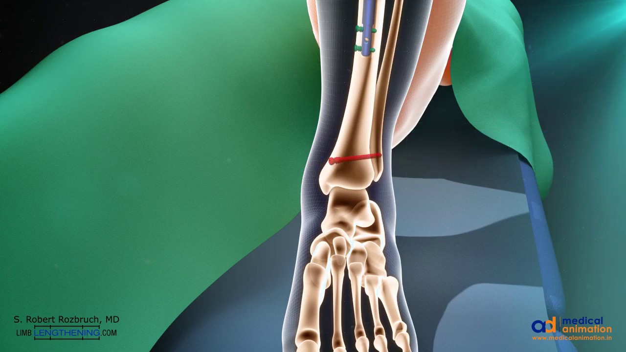 Tibia Lengthening Using Intramedullary PRECICE Nail