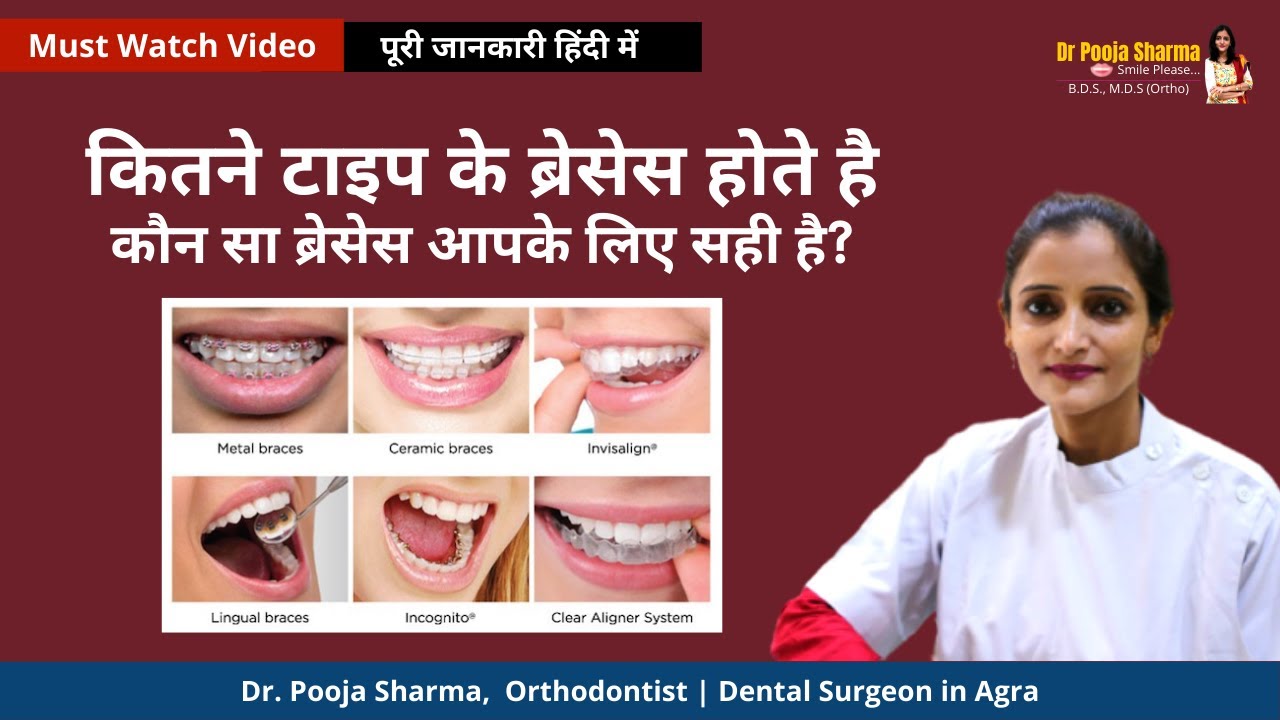 Types of Braces - Know everything about types teeth braces - Orthodontic Treatment | Dr Pooja Sharma