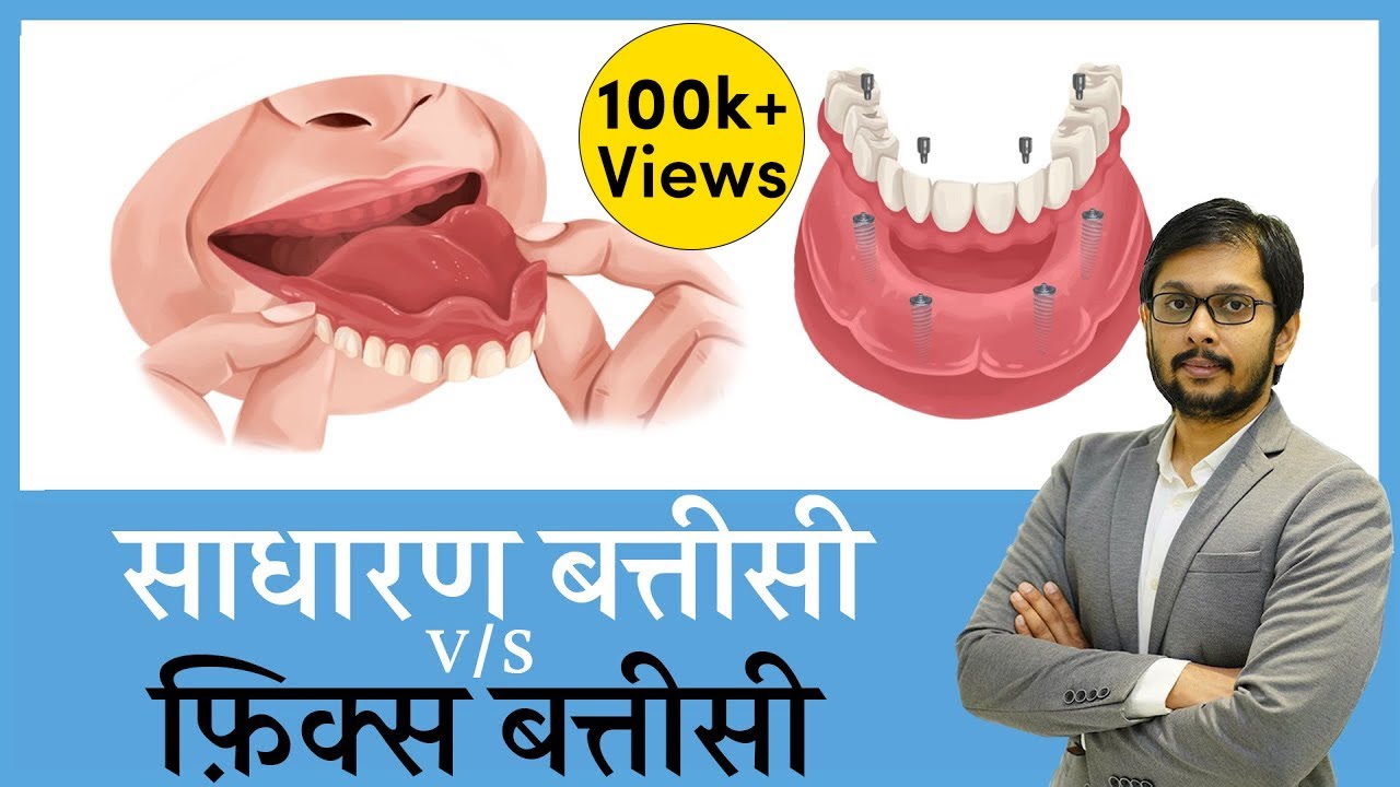 Smart Comparison of Removable Dentures v/s Fix Implant Dentures..all aspects covered!