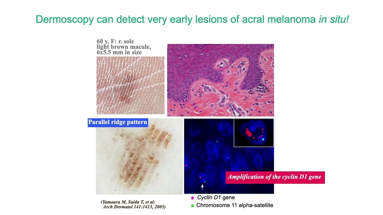 3 Step Algorithm for Acral Melanocytic Lesions - Dr. Toshiaki Saida
