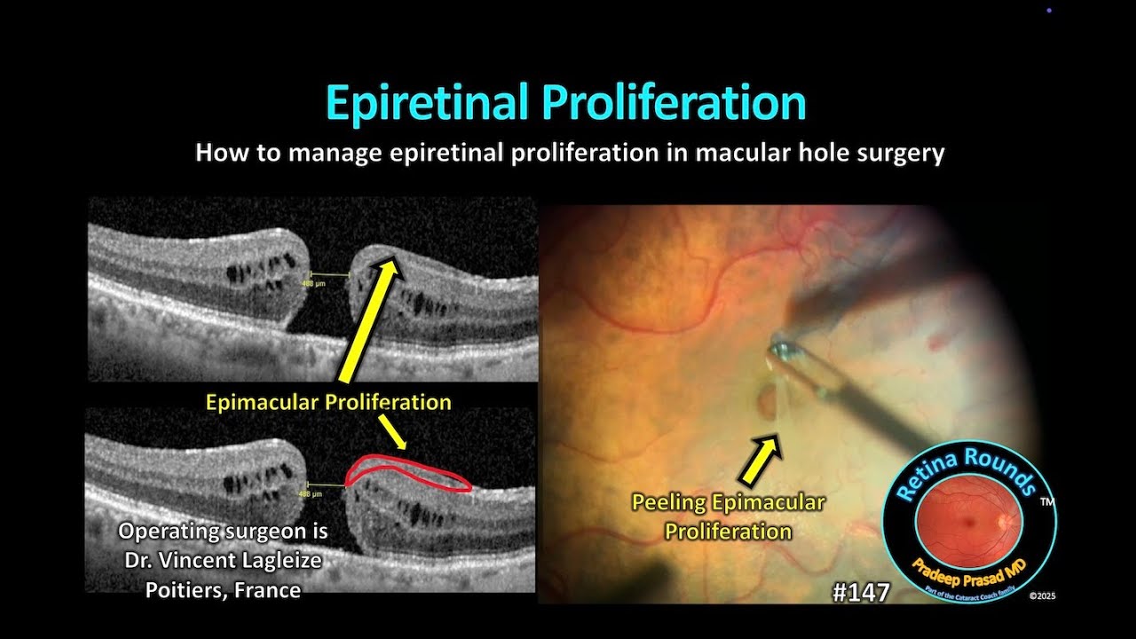 RetinaRounds&trade; 147:  Epiretinal Proliferation