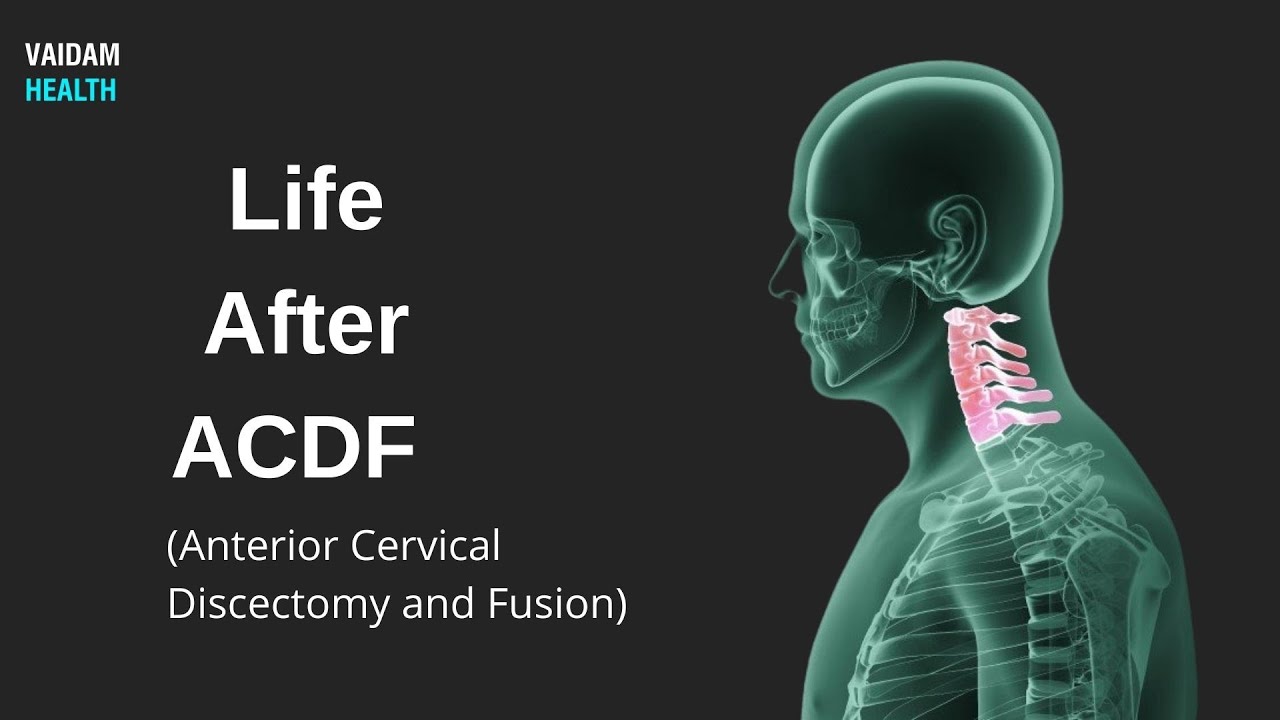 Life After ACDF (Anterior Cervical Discectomy and Fusion)