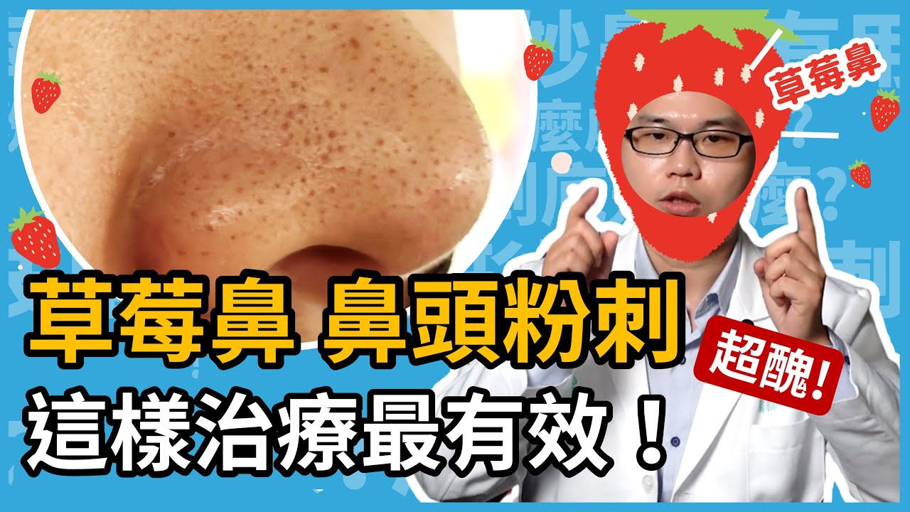 草莓鼻、鼻頭粉刺，黑黑的好醜！這樣治療最有效！妙鼻貼除粉刺有用嗎？小蘇打水真的可以洗掉粉刺嗎？就讓皮膚科楊省三醫師來破除網路謠言！