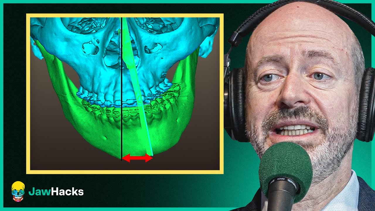 How to Handle Asymmetry in Maxillary Expansion