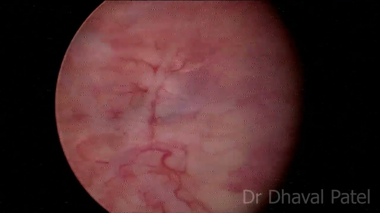 Diagnostic Cystoscopy In Female