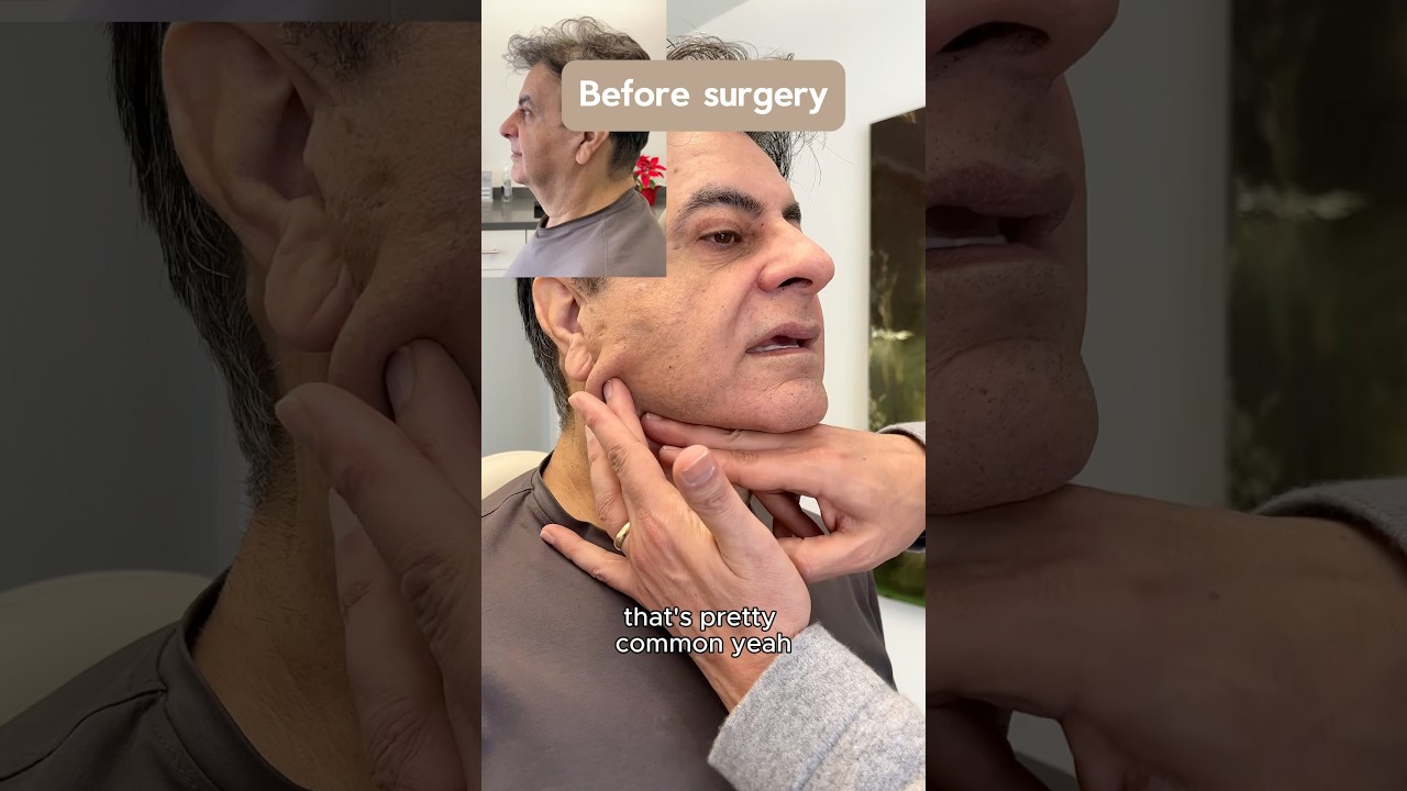 65 y.o. Male Face & Neck Lift Surgery #plasticsurgery #facelift #necklift #drazizzadeh