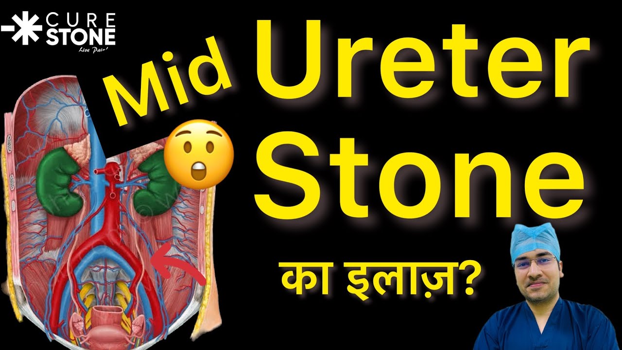 Mid-Ureteral Stones | स्टोन का इलाज क्या है? | Treatment for Kidney Stones in Mid-Ureter?