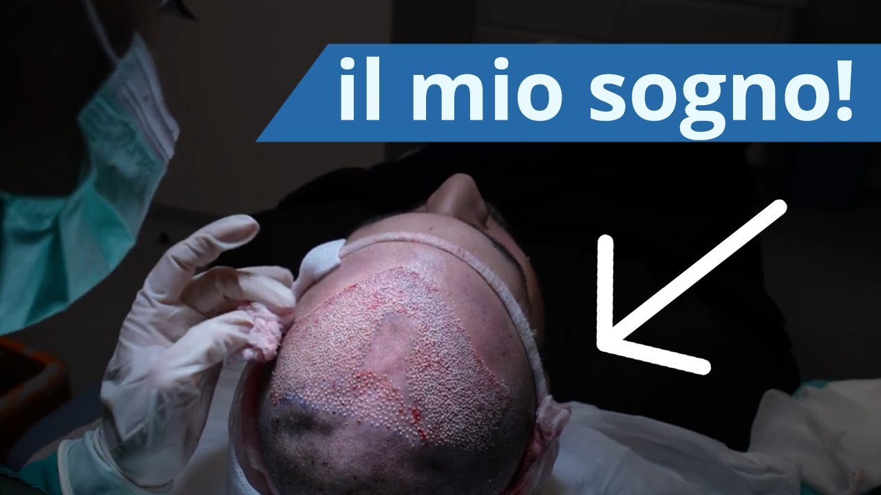 Trapianto di capelli in Turchia: l&rsquo;esperienza di Valerio