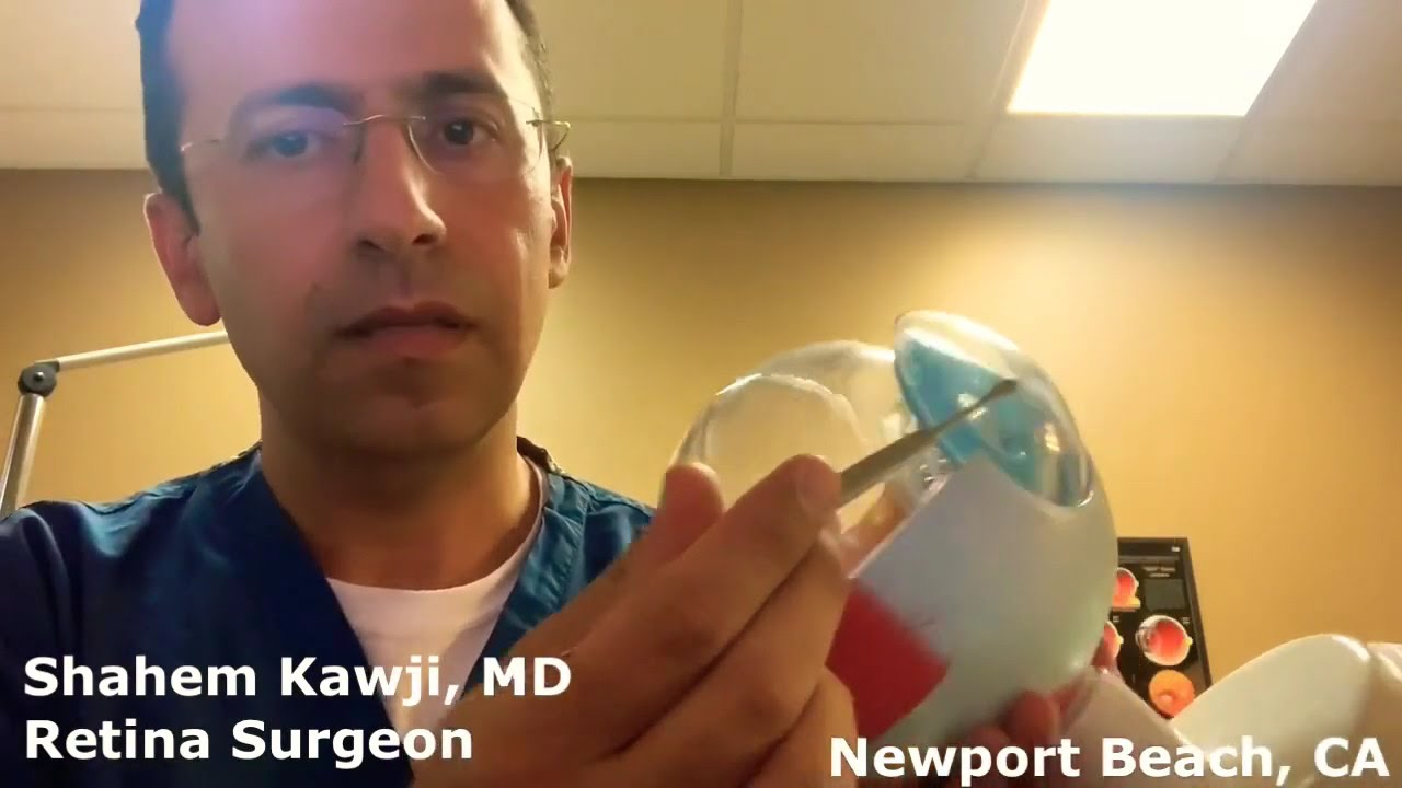 Does the Vitreous Gel Come Back After Vitrectomy Surgery?