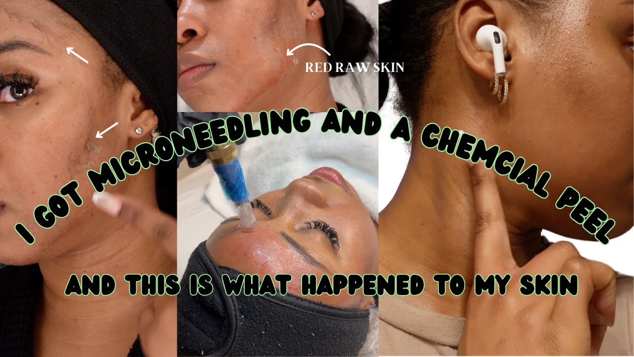 My Skin Transformation after Microneedling + Chemical Peel | Procedure | Daily Updates | Skincare...