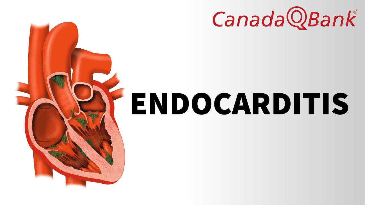 Endocarditis Explained | Causes, Diagnosis & Management | Cardiology | CanadaQBank