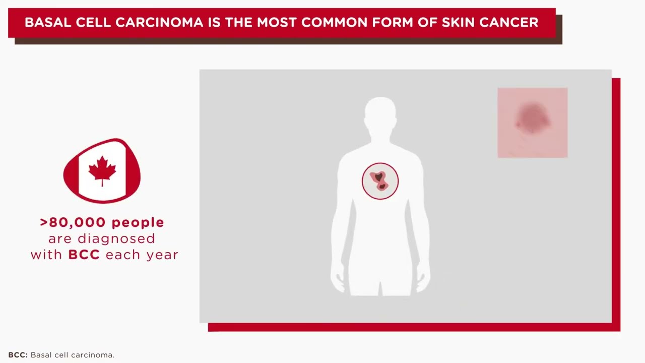 Helping You Understand Basal Cell Carcinoma (BCC)