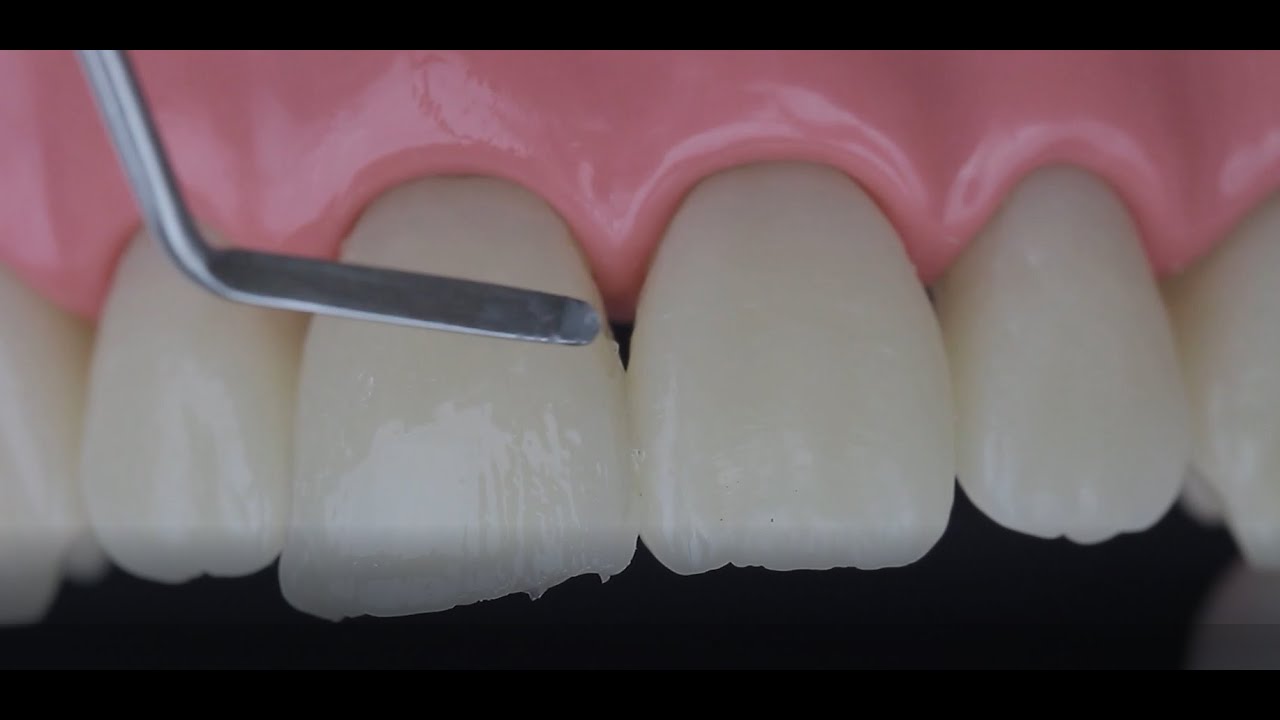 [ESP] Restauración anterior con composites FGM.