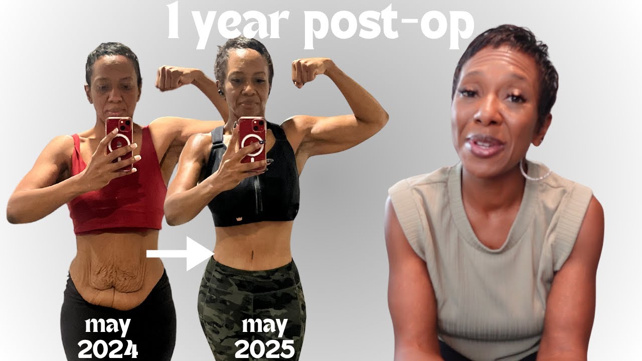 Tummy Tuck Recovery VLOG - One Year Update | Scar, Numbness & Swelling