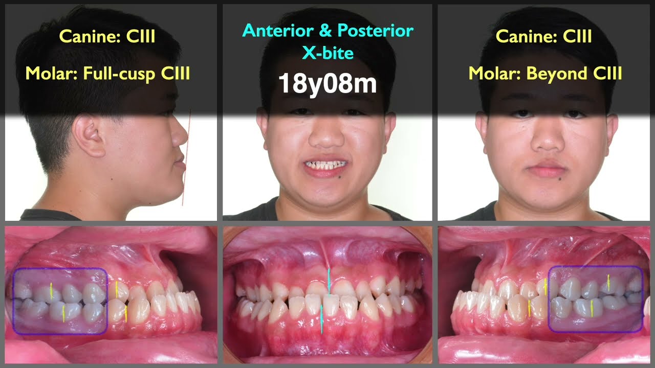 Skeletal Class III with posterior crossbite｜【Chris Chang Ortho】CC749