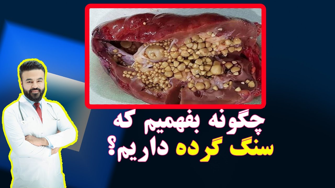سنگ گرده را چگونه تشخیص بدهیم؟ داکتر قیس نیکزاد