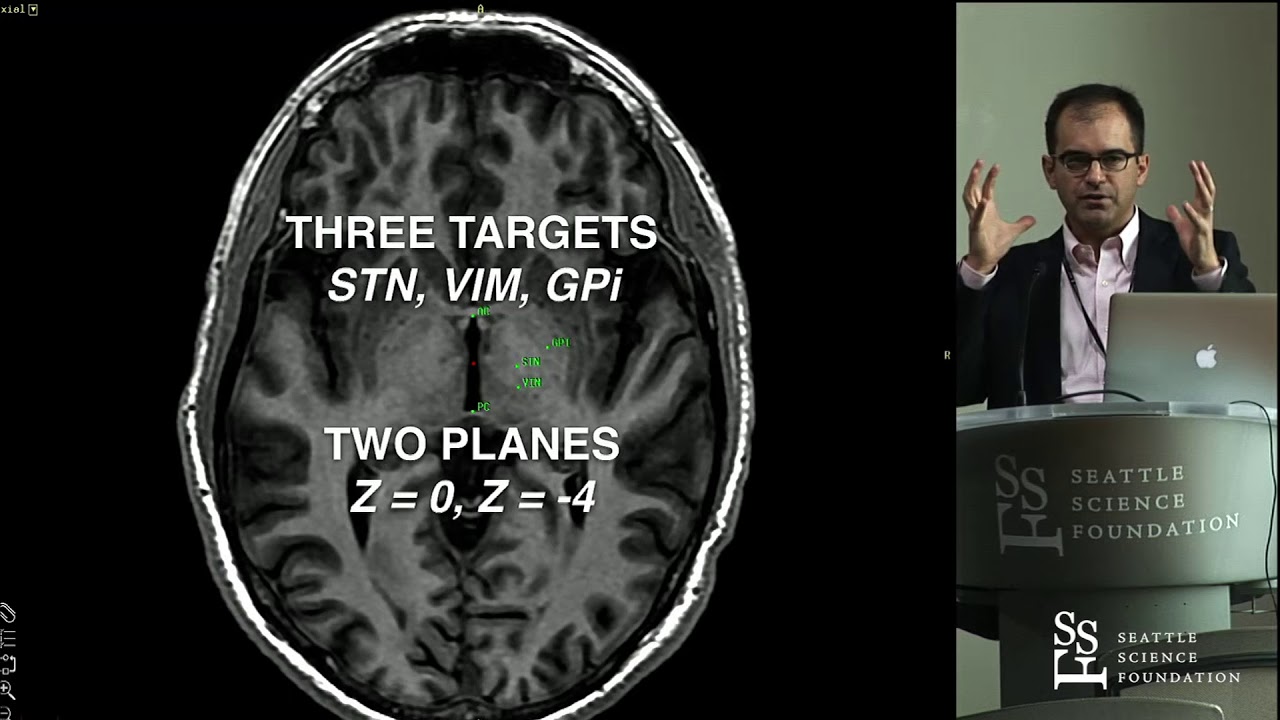 DBS for Movement Disorders - Francisco Ponce, MD, FAANS
