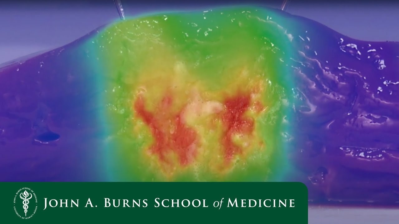 Image Guided Tumor Ablation, L  Hinshaw, MD